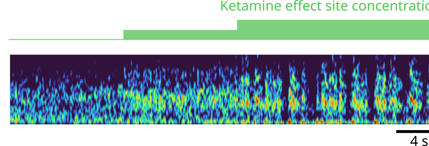 A very horizontal chart plots brain rhythm frequency over time with colors indicating power. Bars along the top indicate the dose of ketamine. After the dose starts more gamma frequency power appears. After the dose gets even higher, the gamma waves periodically stop and then resume.
