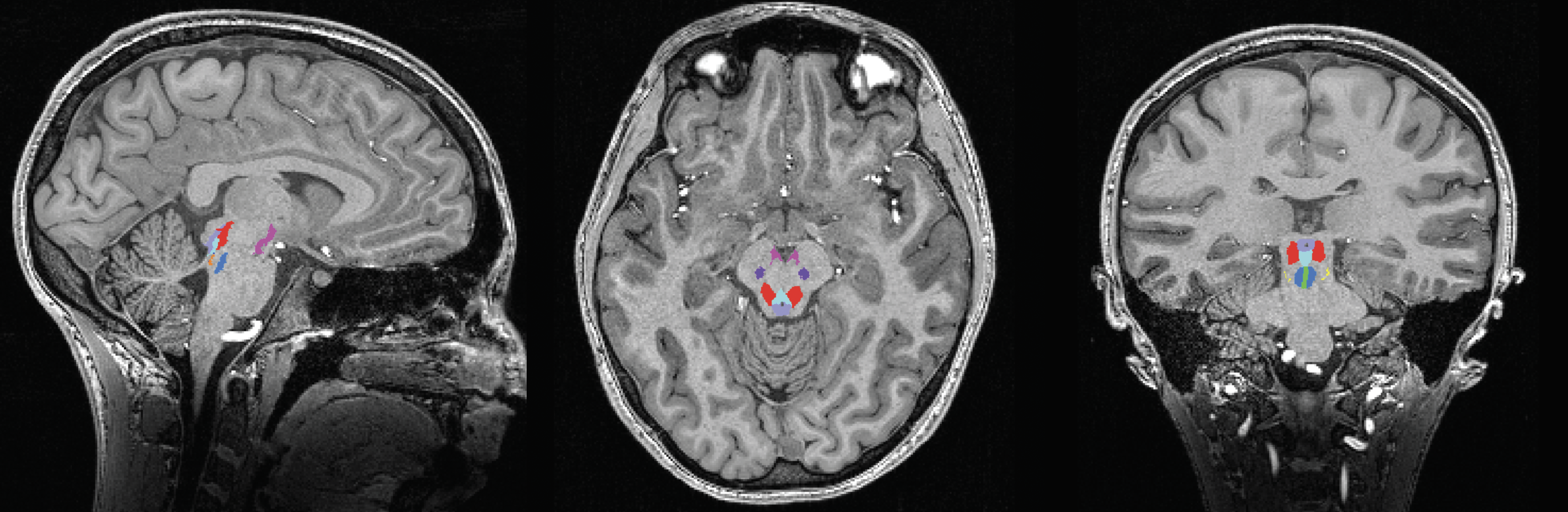Three grayscale MRI images provide different cross sections of the head and brain. In the very middle are small blue and red colored spots