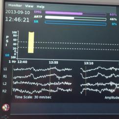 An operating room vital signs monitor shows EEG readings