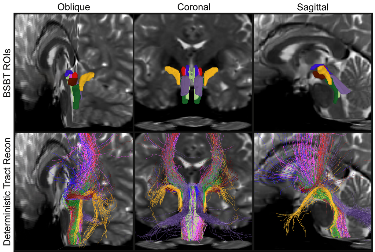 A 3 by 2 array shows three different cross sections of the brainstem in two rows. The top row shows the new tool which highlights in different colors distinct shapes within the brainstem. The bottom row shows finer tracings of fibers, colored the same way, through the brainstem.