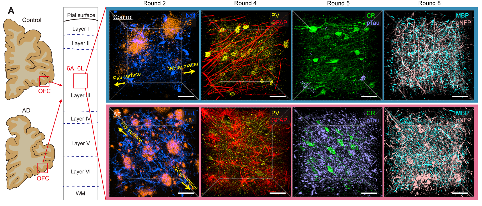 In two rows of four images show colorfully stained single cell resolution pictures of brain tissue from a healthy control on the top and a person with Alzheimer's on the bottom. The Alzheimer's donor's images reveal more of the toxic proteins associated with the disease such as amyloid and tau.