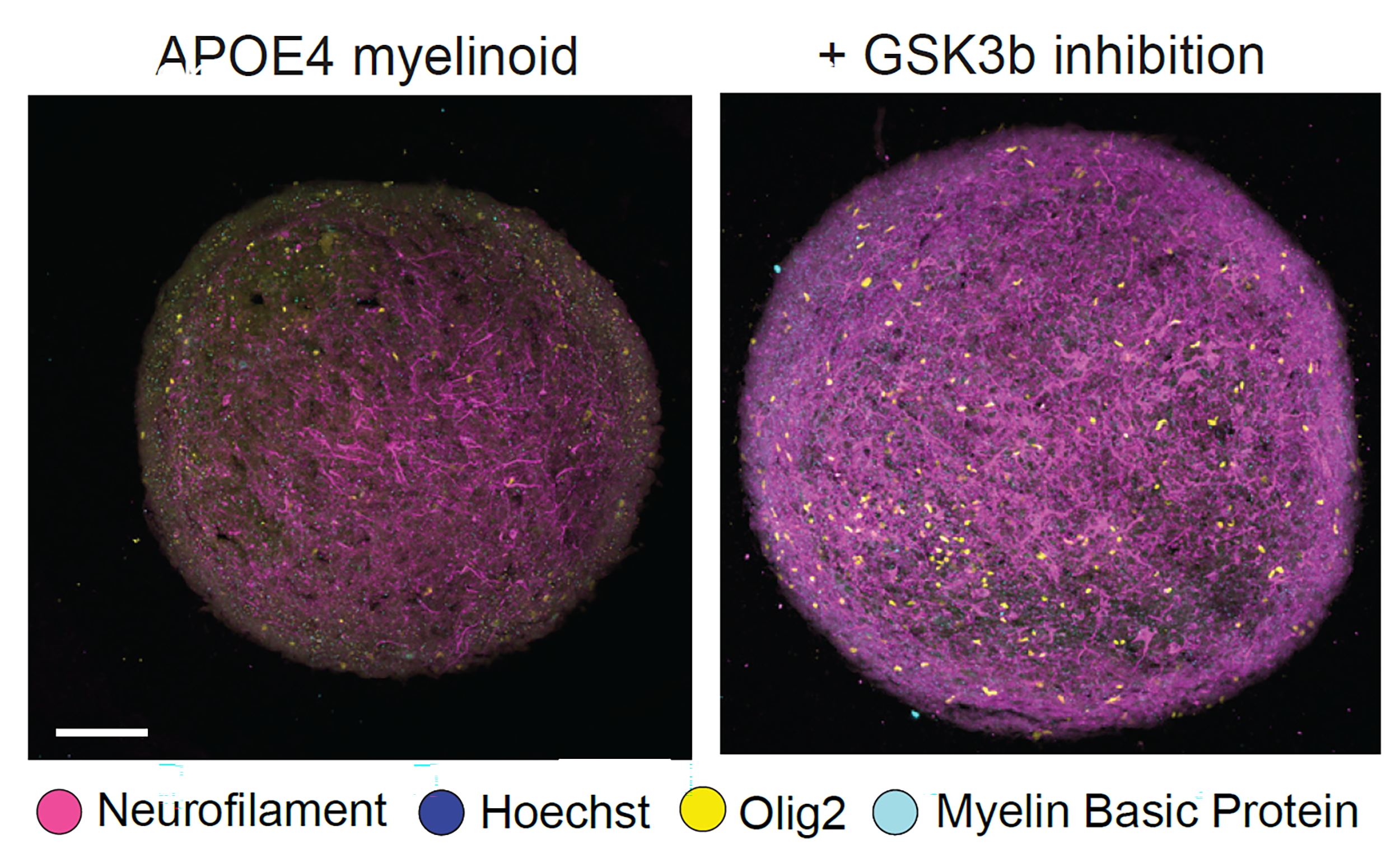Two panels show round cerebral organoids, which appear as a dense tangle of magenta and cyan strands speckled with bright yellow dots. The one on the right, labeled "+Gsk3b inhibition" has much more of the pink strands than the one on the left, labeled "APOE4 myelinoid"