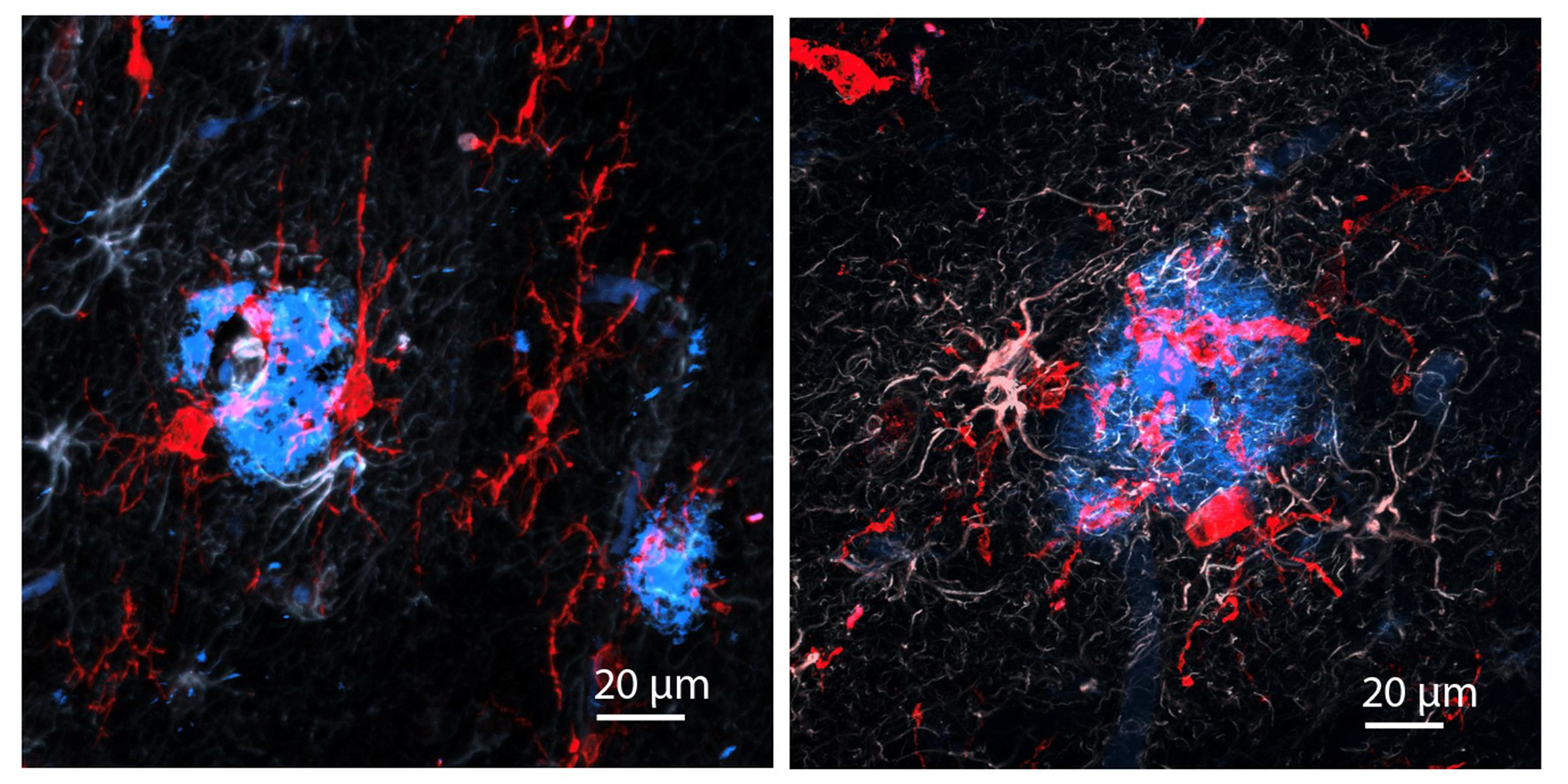 In two panels red microglia surround a bluish blob. In the left panel the microglia are more slender whereas they are more bloated on the right. The blue blub is more compact on the left and more diffuse on the right.