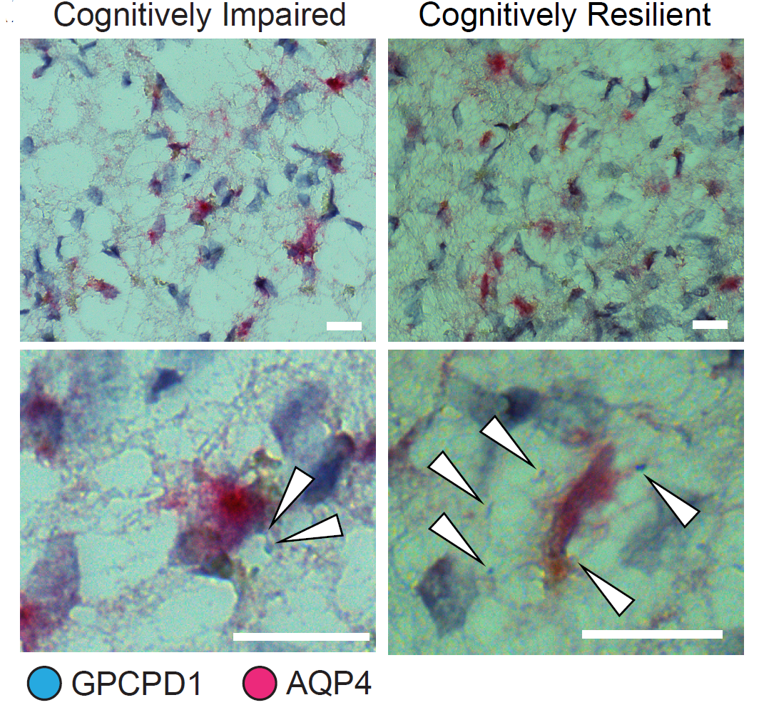 Study across multiple brain regions discerns Alzheimer’s vulnerability and resilience factors