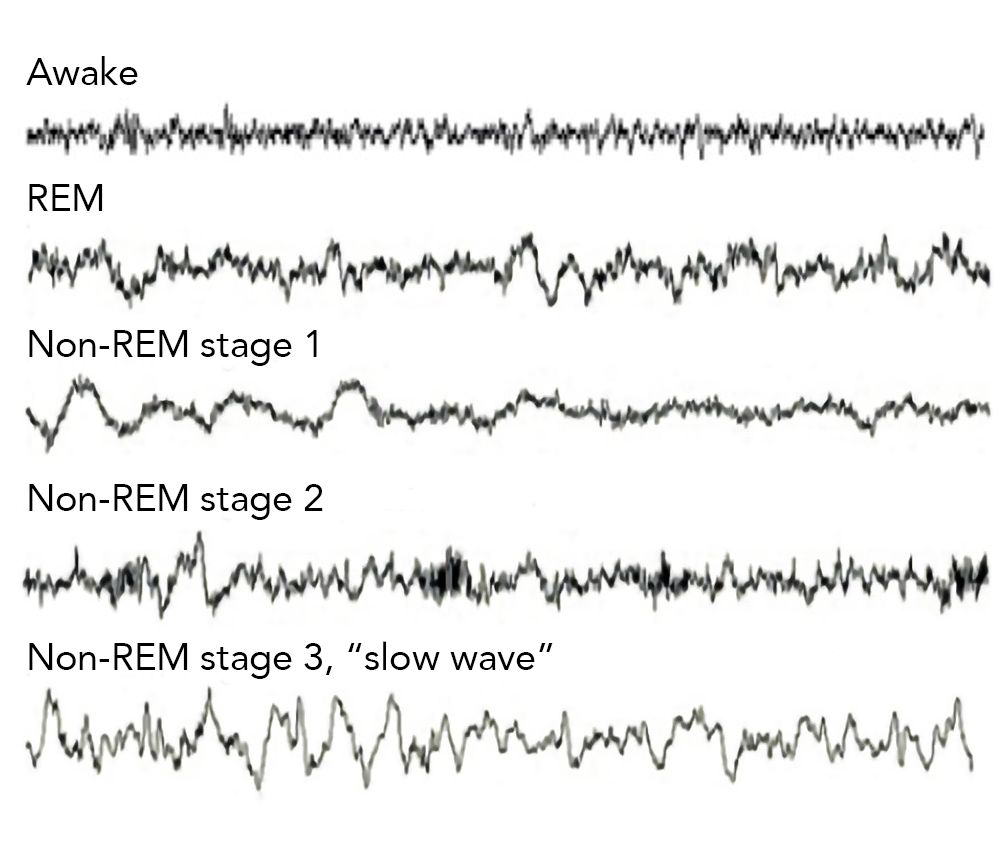 A series of five different brain wave forms squiggle across the image in black on a white background. Each is labeled by its sleep stage (e.g. awake, REM, Non-REM stage 1, etc.)