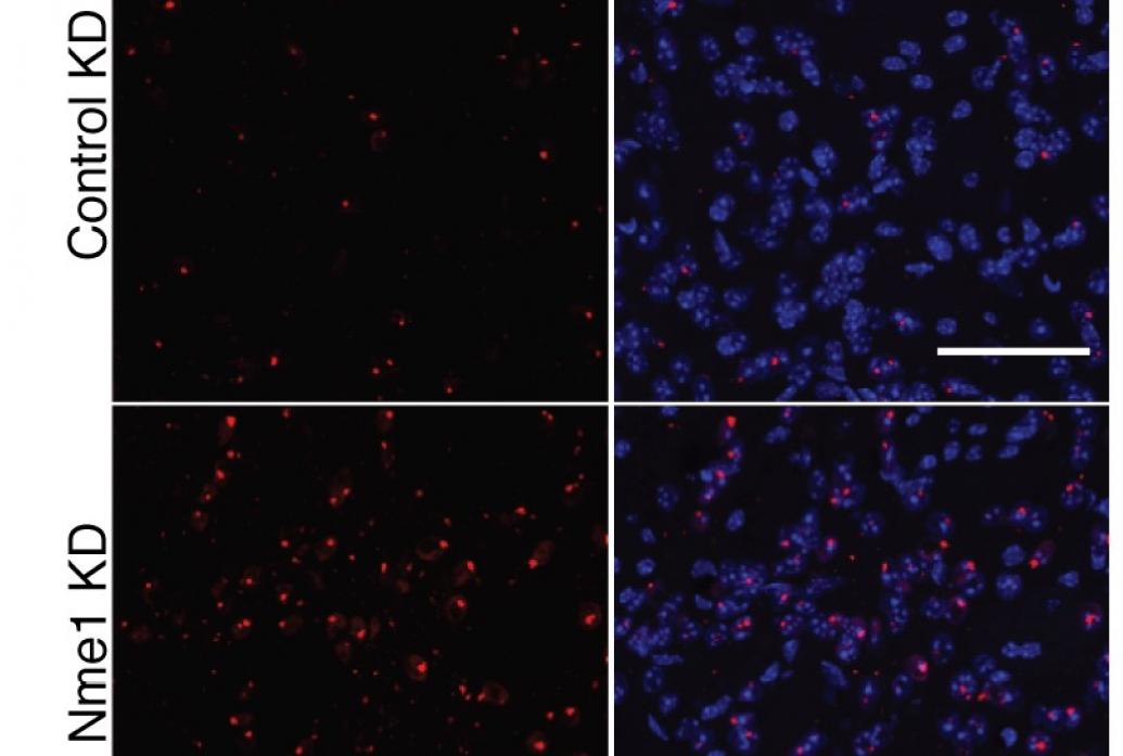 A 2x2 grid of microscop images shows red speckles overlaid on blue blobs. The blue indicates cells. The red indicates aggregated proteins. Where a gene called NME has been knocked down, there are more red speckles on the cells.