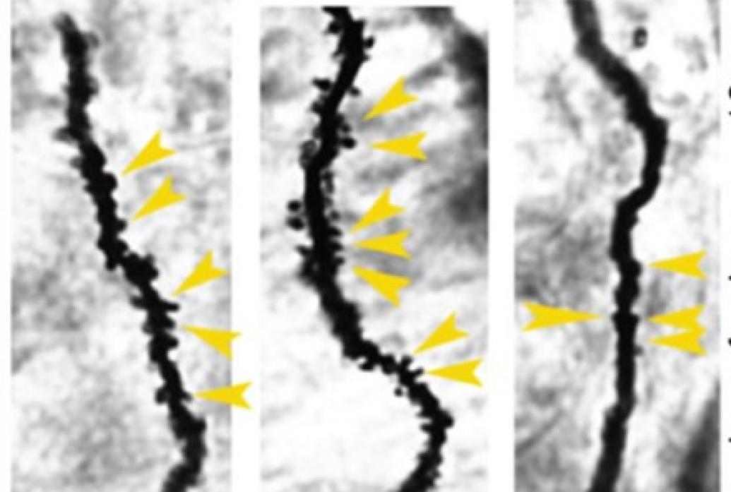 Three vertical panels show bumpy neural branches. The degree of bumps differs from panel to paneland bumps are denoted by yellow arrows.