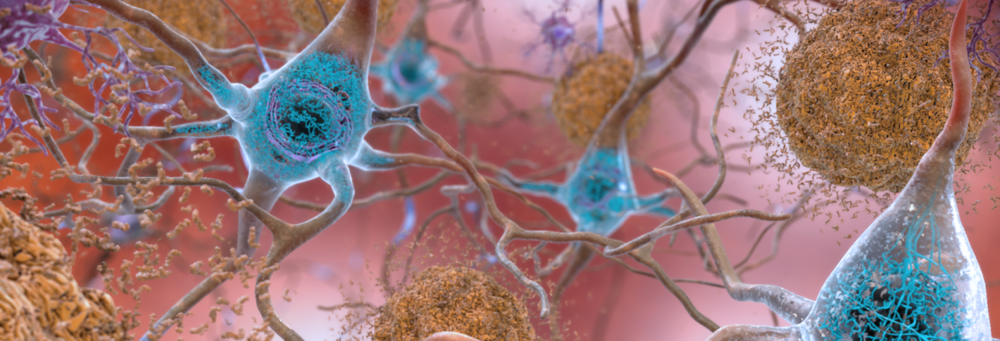 A 3D cartoon closeup of various brain cells on a pink background as they float around amid spherical clumps of amyloid proteins.