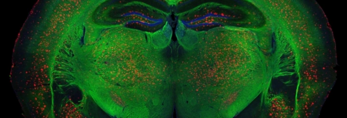 Beta-amyloid plaque deposits (red) disrupt mylelin (green) organization in the brain and activate microglia (orange), driving the inflammation, neurodegeneration, and cognitive disfunction associated with Alzheimer's disease.