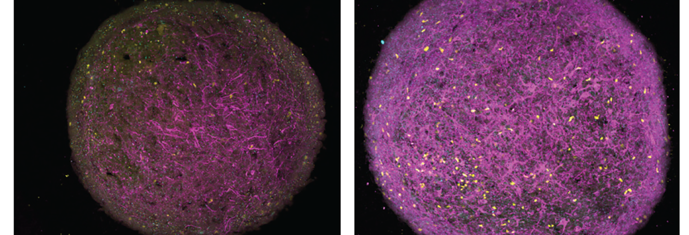 Two panels show round cerebral organoids, which appear as a dense tangle of magenta and cyan strands speckled with bright yellow dots. The one on the right, labeled "+Gsk3b inhibition" has much more of the pink strands than the one on the left, labeled "APOE4 myelinoid"