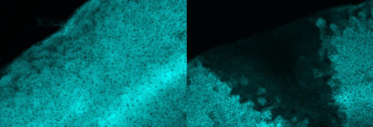 Two square images side by side show arcs of thousands of densely-packed brain cells stained in cyan. On the left the arc is uninterrupted but on the right the arc features a dark wedge of no cyan staining.