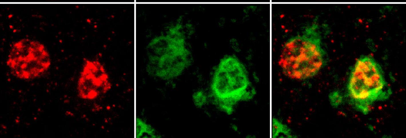 An array of six images shows that oligodendrocytes high in amyloid also express more of two proteins