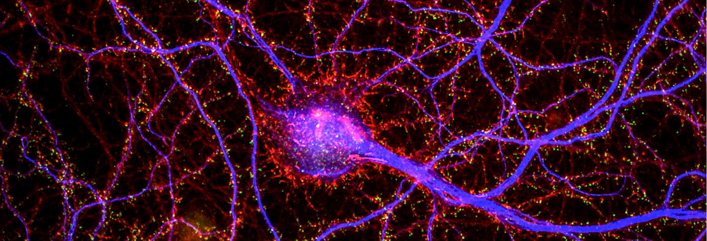 A red and purple stained neuron hiighlights its many branched and spiny dendrites