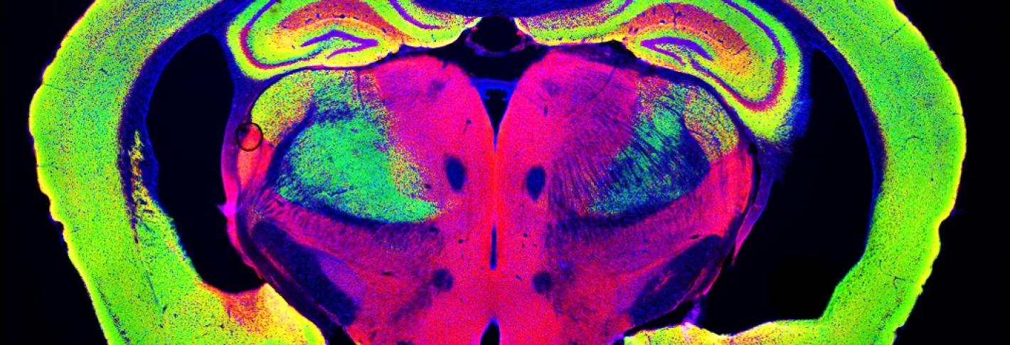Slice through a mouse brain shows huge ventricles opened up by neurodegeneration in a p25 mouse