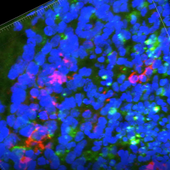 An organoid with APOE4 shows microglia in red an amyloid plaque in green