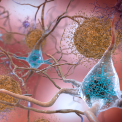 A 3D cartoon closeup of various brain cells on a pink background as they float around amid spherical clumps of amyloid proteins.