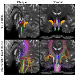 A 3 by 2 array shows three different cross sections of the brainstem in two rows. The top row shows the new tool which highlights in different colors distinct shapes within the brainstem. The bottom row shows finer tracings of fibers, colored the same way, through the brainstem.